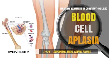 Constitutional Red Blood Cell Aplasia: Understanding Root Causes