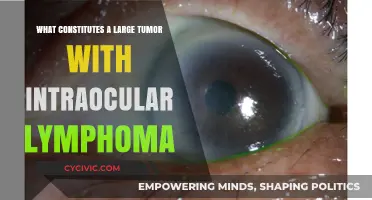 Understanding Large Tumors: Intraocular Lymphoma Diagnosis