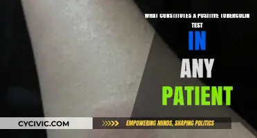 Tuberculin Test Positivity: Understanding the Factors