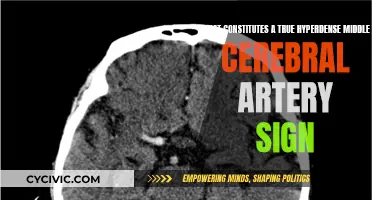 Understanding the True Hyperdense Middle Cerebral Artery Sign