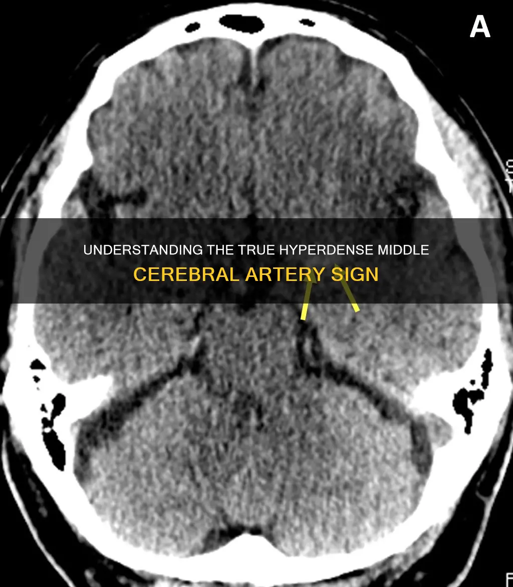 what constitutes a true hyperdense middle cerebral artery sign