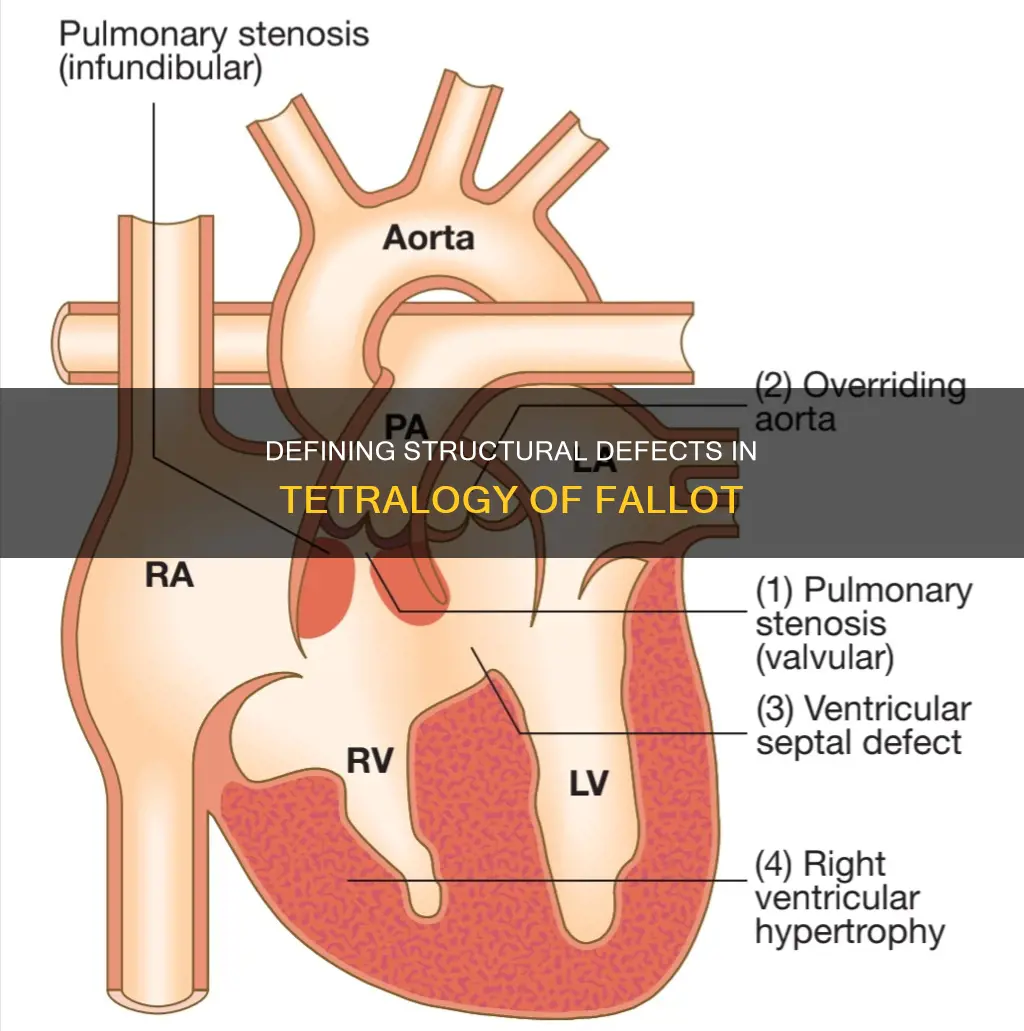 which of the following structural defects constitute tetralogy of fallot